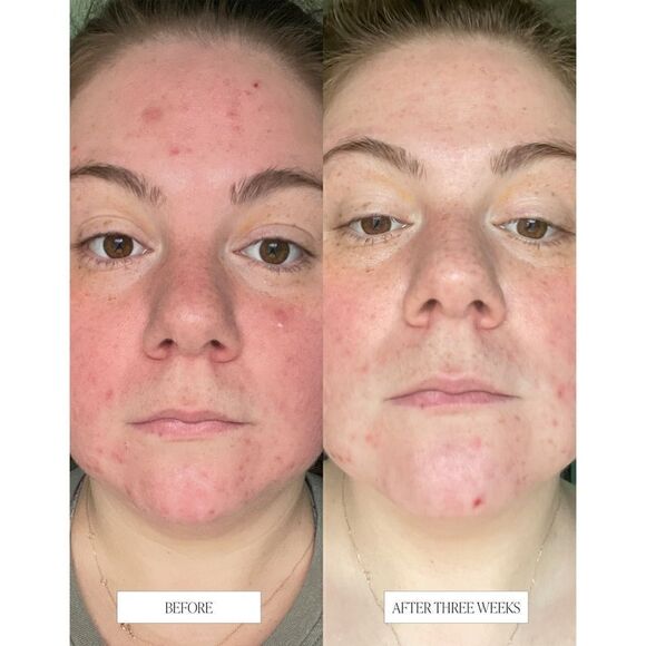 NIB BYROE NEW YORK Celery AHA + LHA Resurfacing Serum, 1.01 FL. OZ. / 30 ML - Picture 10 of 16